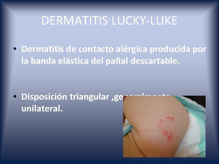 DERMATITIS LUCKY-LUKE • Dermatitis de contacto alérgica producida por la banda elástica del pañal