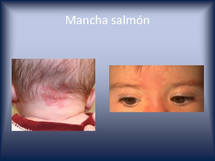 Mancha salmón 