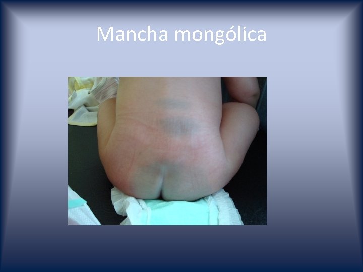 Mancha mongólica 