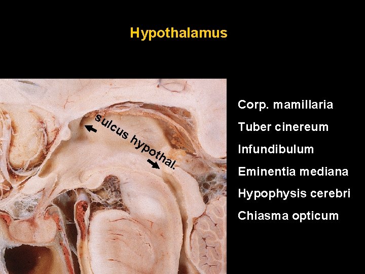 Hypothalamus su Corp. mamillaria lcu Tuber cinereum sh yp oth al. Infundibulum Eminentia mediana