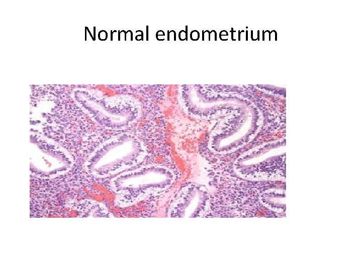 Normal endometrium 