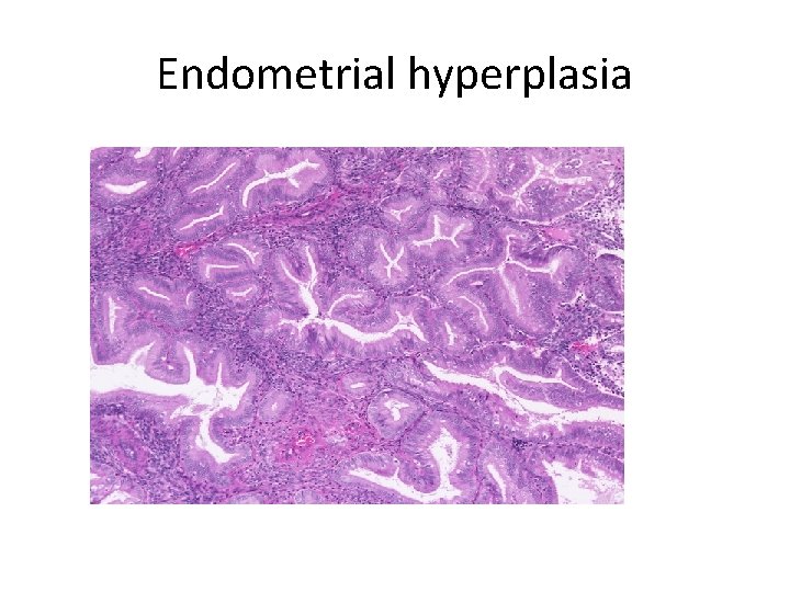 Endometrial hyperplasia 