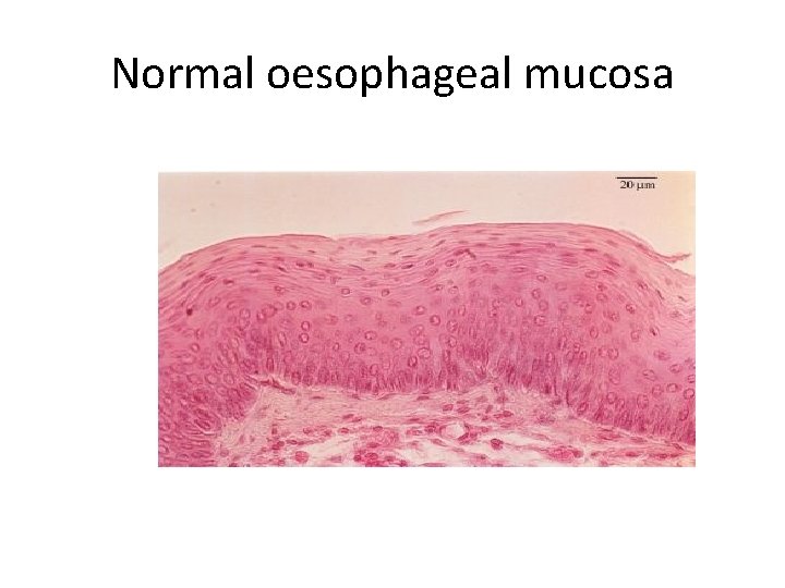 Normal oesophageal mucosa 