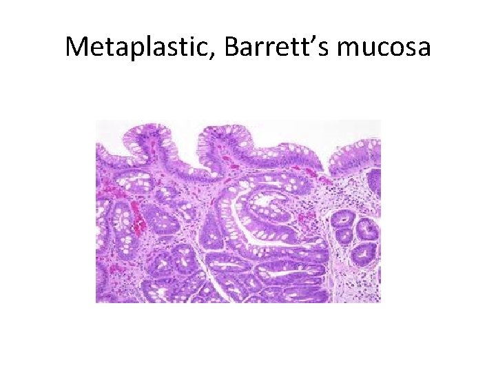 Metaplastic, Barrett’s mucosa 