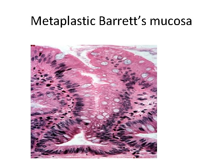 Metaplastic Barrett’s mucosa 