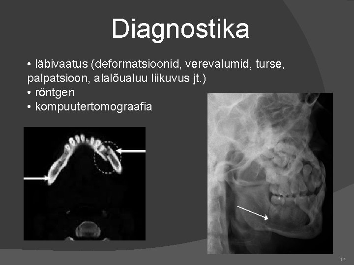 Diagnostika • läbivaatus (deformatsioonid, verevalumid, turse, palpatsioon, alalõualuu liikuvus jt. ) • röntgen •