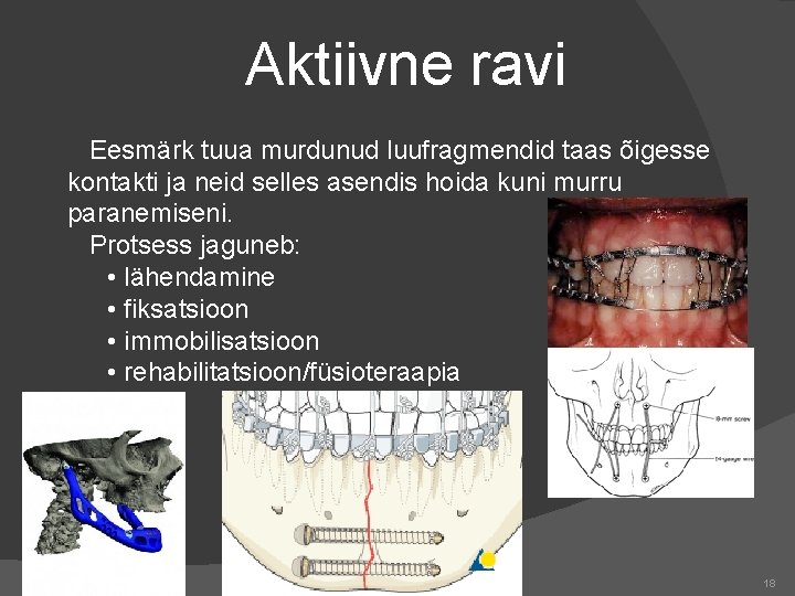 Aktiivne ravi Eesmärk tuua murdunud luufragmendid taas õigesse kontakti ja neid selles asendis hoida