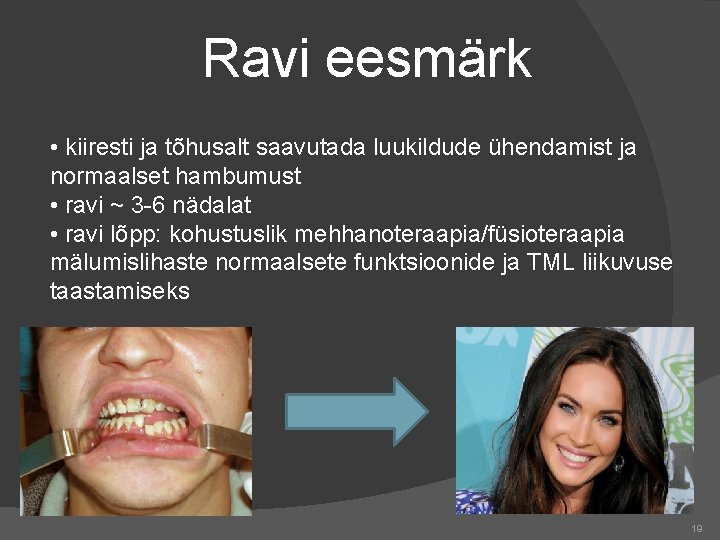 Ravi eesmärk • kiiresti ja tõhusalt saavutada luukildude ühendamist ja normaalset hambumust • ravi