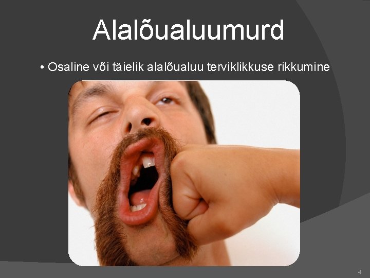 Alalõualuumurd • Osaline või täielik alalõualuu terviklikkuse rikkumine 4 