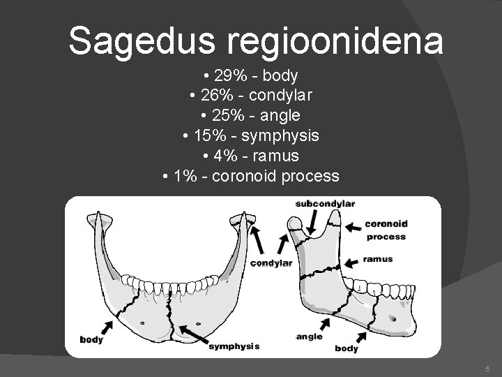 Sagedus regioonidena • 29% - body • 26% - condylar • 25% - angle