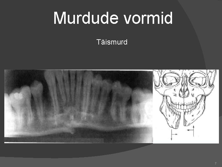 Murdude vormid Täismurd 7 