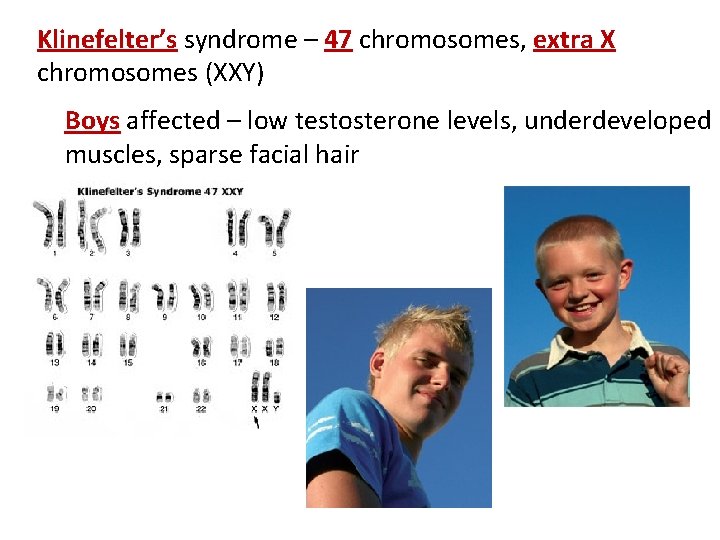 Klinefelter’s syndrome – 47 chromosomes, extra X chromosomes (XXY) Boys affected – low testosterone