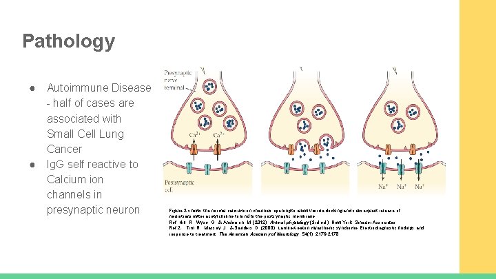 Pathology ● ● Autoimmune Disease - half of cases are associated with Small Cell