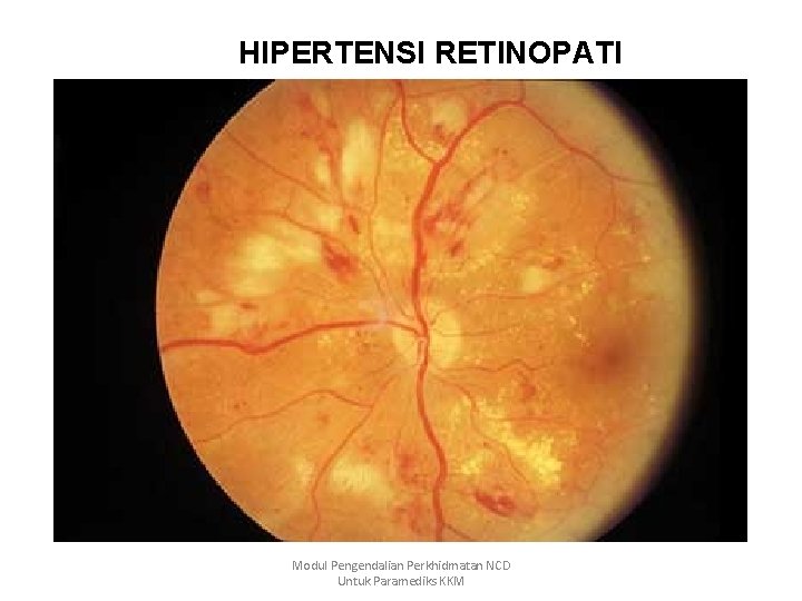 HIPERTENSI RETINOPATI Modul Pengendalian Perkhidmatan NCD Untuk Paramediks KKM 