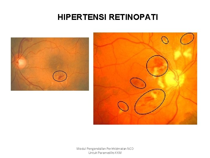 HIPERTENSI RETINOPATI Modul Pengendalian Perkhidmatan NCD Untuk Paramediks KKM 