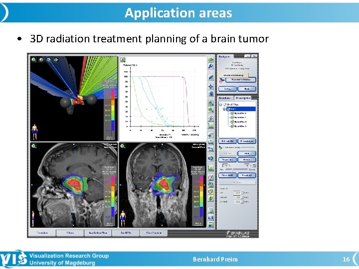 Application areas • 3 D radiation treatment planning of a brain tumor Bernhard Preim