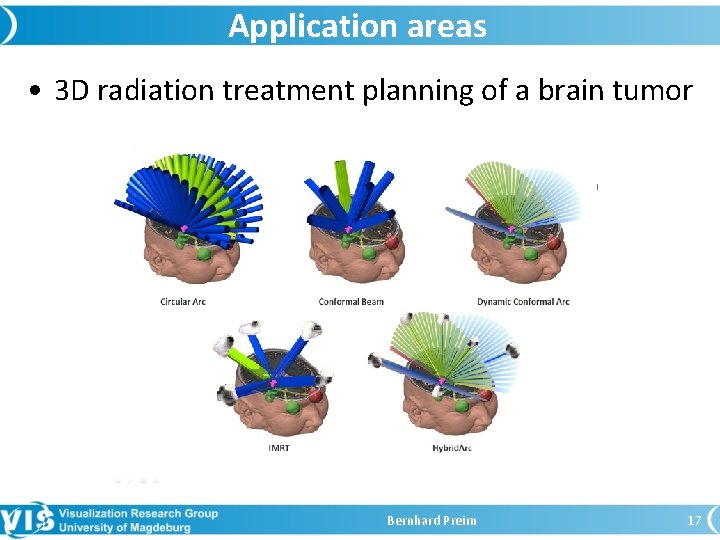 Application areas • 3 D radiation treatment planning of a brain tumor Bernhard Preim