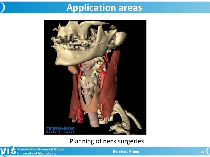 Application areas Planning of neck surgeries Bernhard Preim 20 