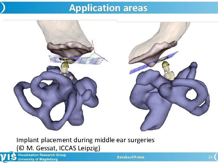 Application areas Implant placement during middle ear surgeries (© M. Gessat, ICCAS Leipzig) Bernhard