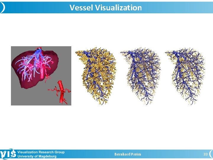 Vessel Visualization Bernhard Preim 33 
