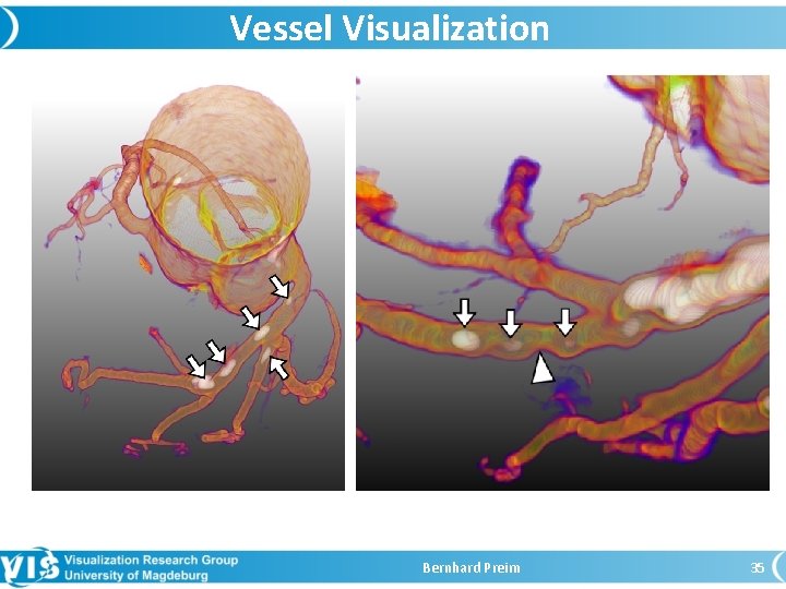 Vessel Visualization Bernhard Preim 35 