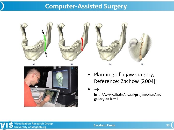 Computer-Assisted Surgery • Planning of a jaw surgery, Reference: Zachow [2004] • → http: