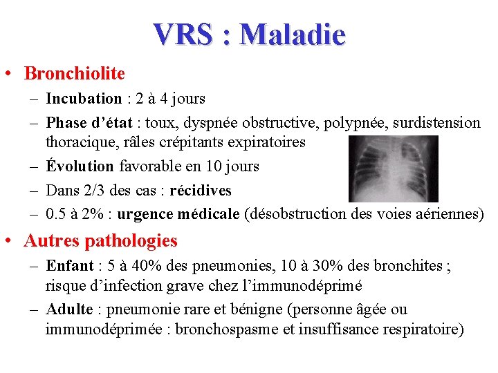 VRS : Maladie • Bronchiolite – Incubation : 2 à 4 jours – Phase