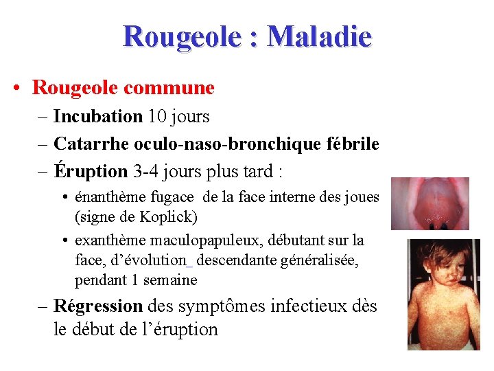 Rougeole : Maladie • Rougeole commune – Incubation 10 jours – Catarrhe oculo-naso-bronchique fébrile