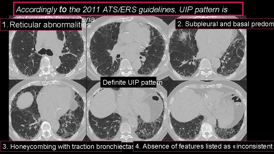 Accordingly to the 2011 ATS/ERS guidelines, UIP pattern is defined by four criteria: 2.