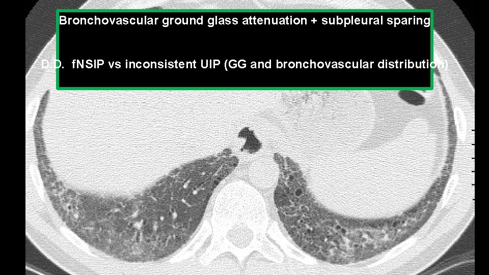 Bronchovascular ground glass attenuation + subpleural sparing D. D. f. NSIP vs inconsistent UIP