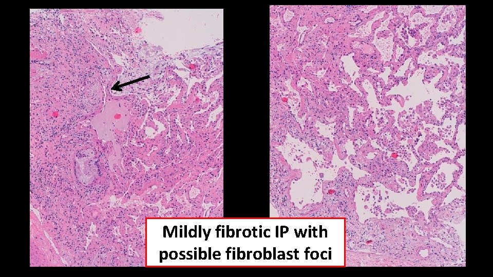 Mildly fibrotic IP with possible fibroblast foci 