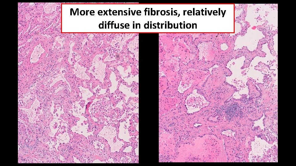 More extensive fibrosis, relatively diffuse in distribution 