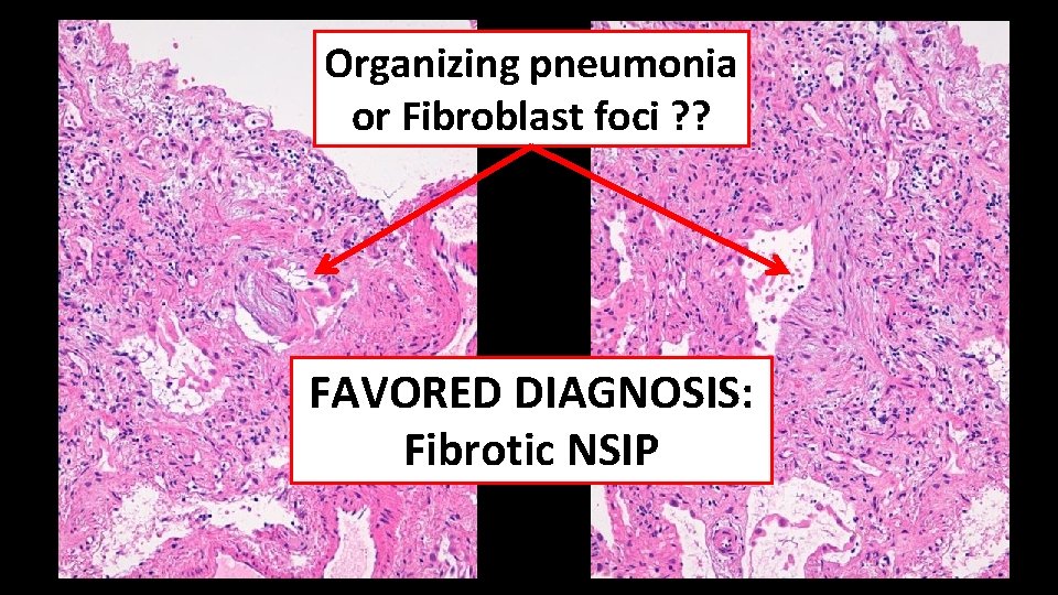 Organizing pneumonia or Fibroblast foci ? ? FAVORED DIAGNOSIS: Fibrotic NSIP 