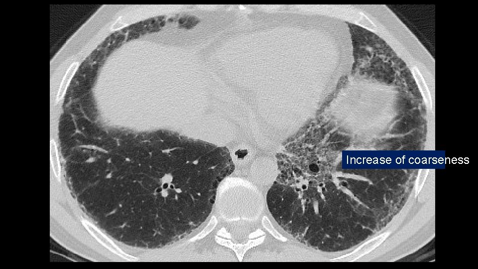 Increase of coarseness 