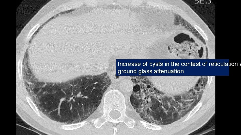 Increase of cysts in the contest of reticulation a ground glass attenuation 