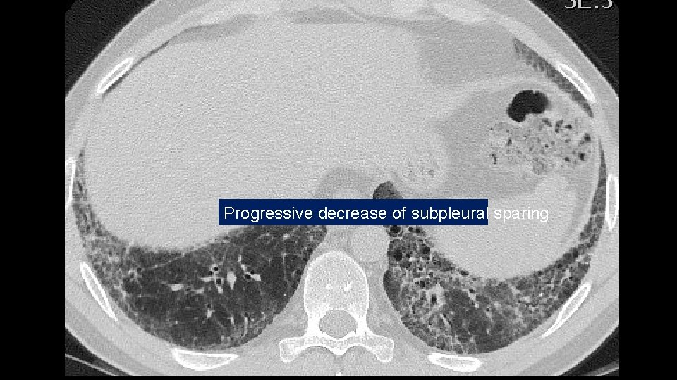 Progressive decrease of subpleural sparing 
