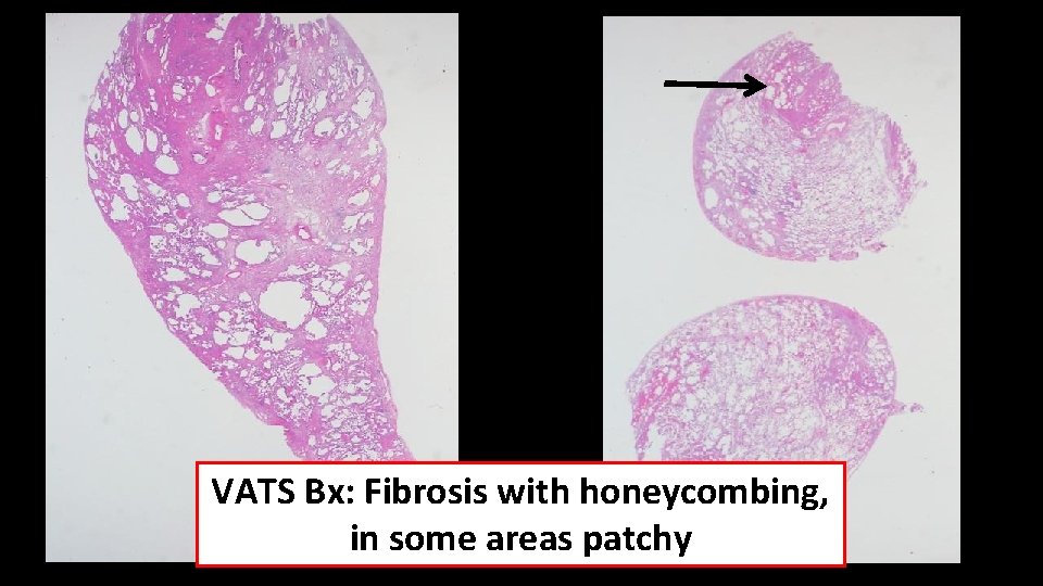 VATS Bx: Fibrosis with honeycombing, in some areas patchy 