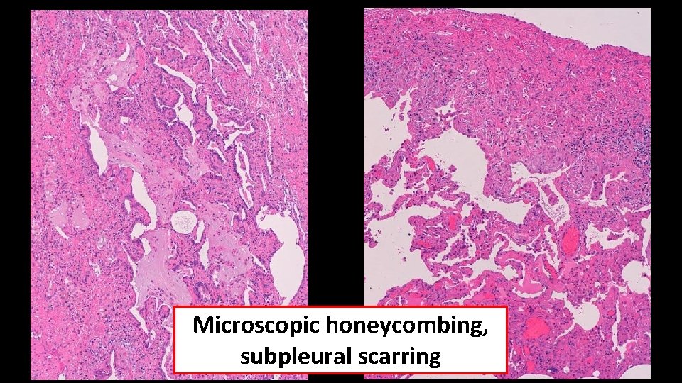 Microscopic honeycombing, subpleural scarring 