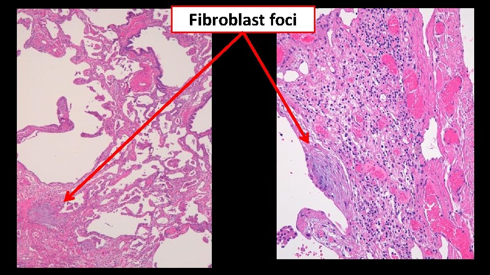 Fibroblast foci 