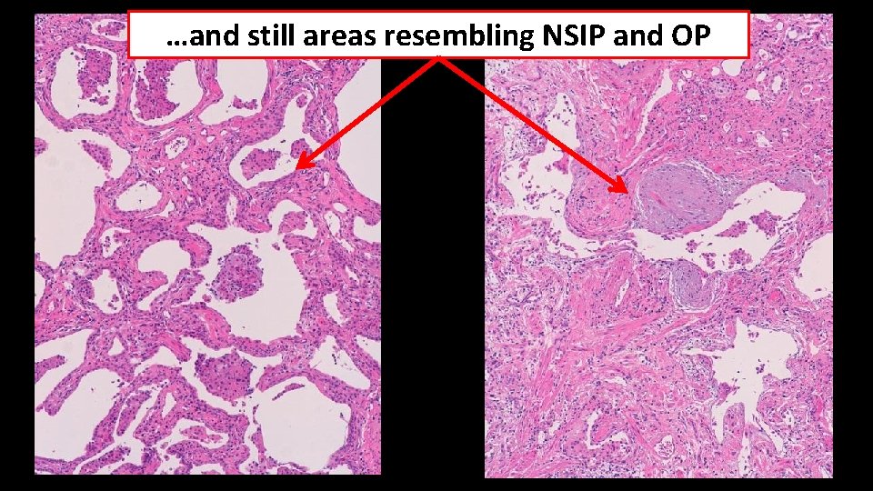 …and still areas resembling NSIP and OP 