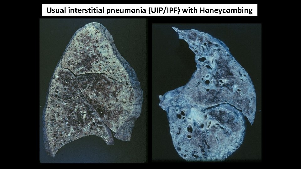 Usual interstitial pneumonia (UIP/IPF) with Honeycombing 