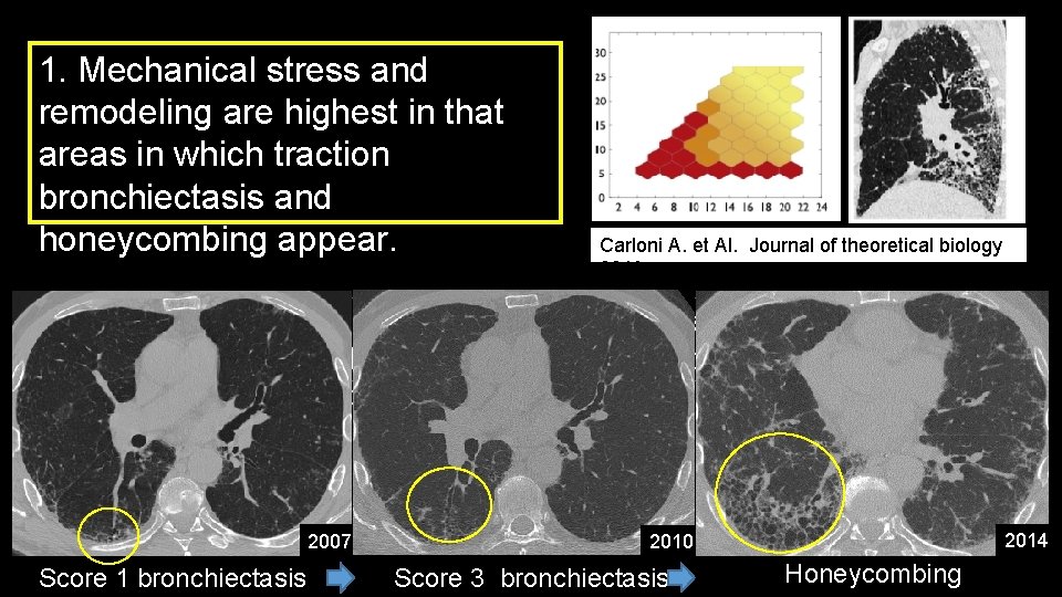 1. Mechanical stress and remodeling are highest in that areas in which traction bronchiectasis