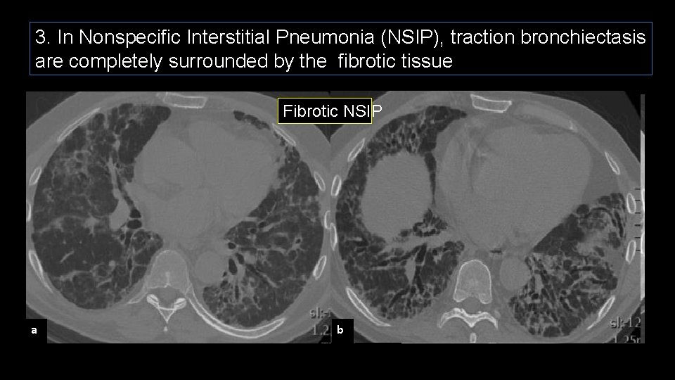 3. In Nonspecific Interstitial Pneumonia (NSIP), traction bronchiectasis are completely surrounded by the fibrotic