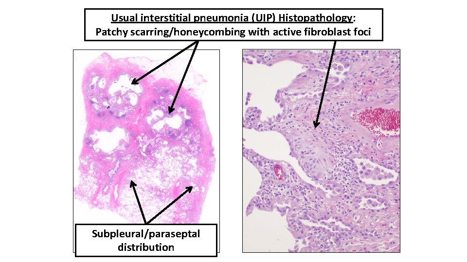 Usual interstitial pneumonia (UIP) Histopathology: Patchy scarring/honeycombing with active fibroblast foci Subpleural/paraseptal distribution 