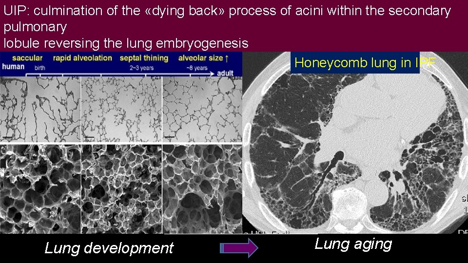 UIP: culmination of the «dying back» process of acini within the secondary pulmonary lobule