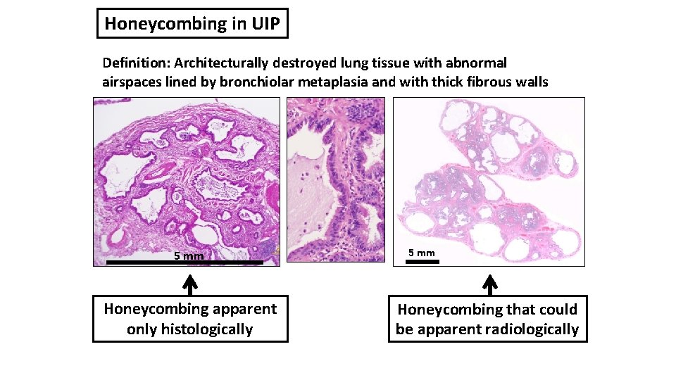 Honeycombing in UIP Definition: Architecturally destroyed lung tissue with abnormal airspaces lined by bronchiolar