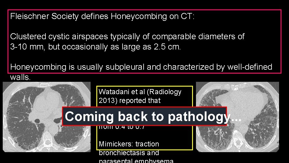 Fleischner Society defines Honeycombing on CT: Clustered cystic airspaces typically of comparable diameters of