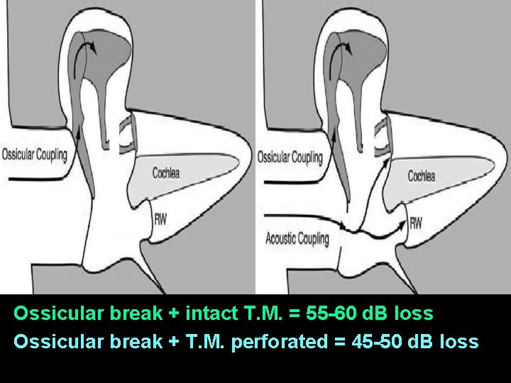 Ossicular break + intact T. M. = 55 -60 d. B loss Ossicular break