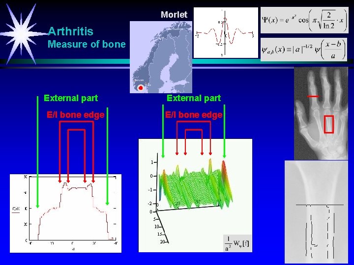 Morlet Arthritis Measure of bone External part E/I bone edge 