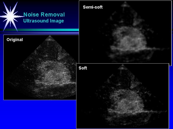 Semi-soft Noise Removal Ultrasound Image Original Soft 